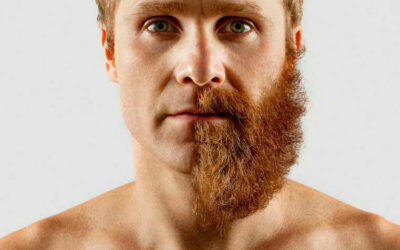 Implante de Barba: o que é, onde fazer e como?