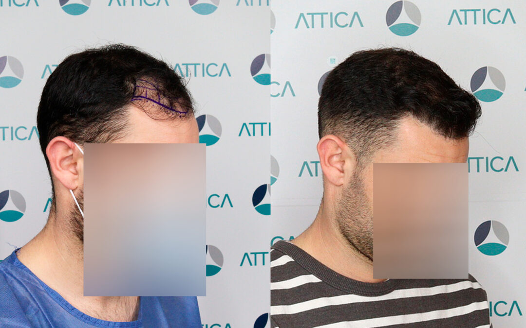 Trasplante de Pelo: Resultados de un paciente!